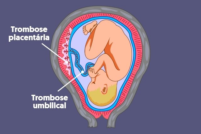 Https Tuasaude Thrombose Na Placenta Maestria Salud