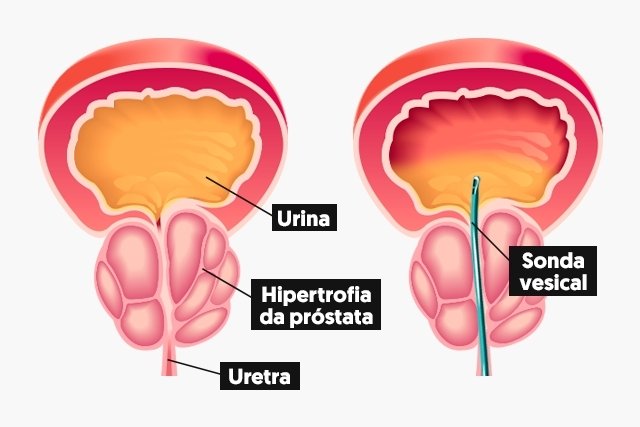 Https Tuasaude Com Caterismo Vesical Maestria Salud