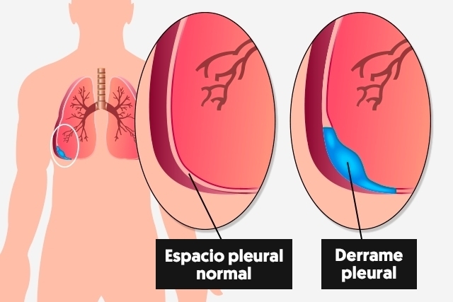 Derrame Pleural Tipos Causas Sintomas E Tratamento The Best Porn Website