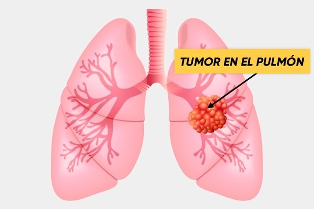 Cáncer De Pulmón Los 10 Síntomas Principales Y El Diagnóstico Maestria Salud 3595